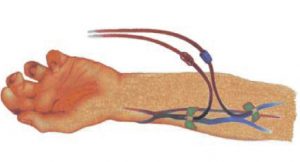 Fistule artério-veineuse